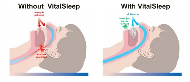 Vitalsleep snoring mouthpiece