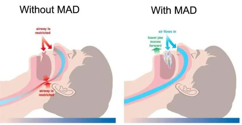 how mad devices work