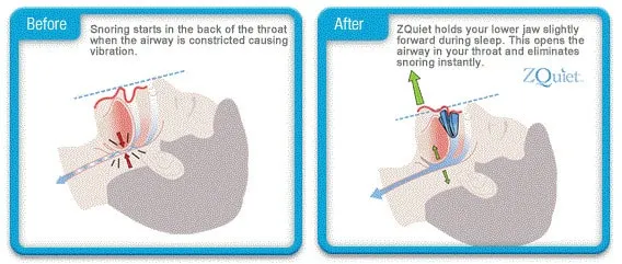 zquiet review trial and cost