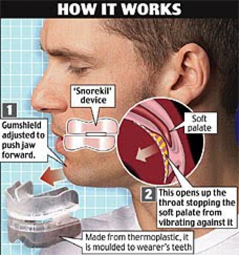 Best AntiSnoring Mouthpieces Reviews & Buying Guide